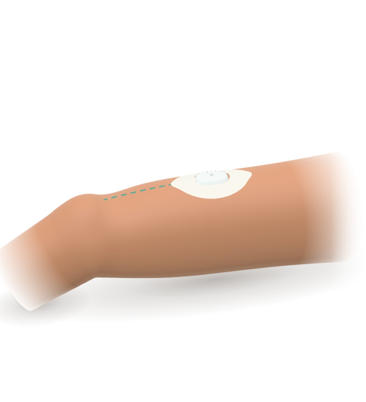 Sibionics GS1 sensor with its patch on the back of the upper arm